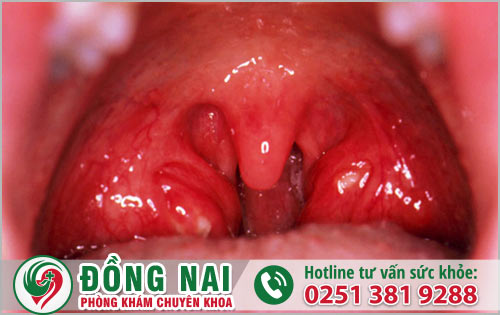 Hình ảnh ung thư vòm họng (Hình 5)