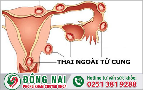 Thai ngoài tử cung là gì và dấu hiệu ra sao?