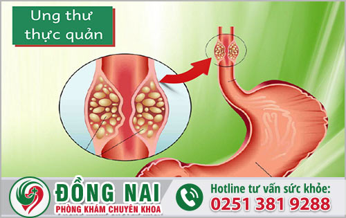 Nguyên nhân và biểu hiện của ung thư thực quản