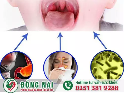 Viêm họng hạt mãn tính có nguy hiểm và chữa được không ?
