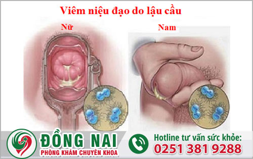 Viêm niệu đạo do lậu có ảnh hướng đến sức khỏe không?