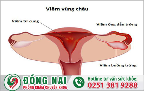 Viêm vùng chậu có gặp phải biến chứng gì không?