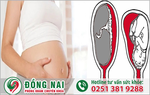 Thai nhi bị vôi hóa nhau thai độ 3 gây tắc nghẽn mạch máu 