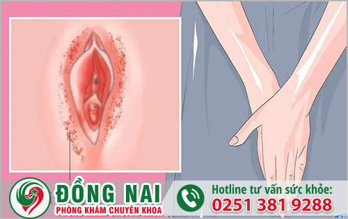 Vùng kín bị ngứa và nổi hạt là bị bệnh gì?