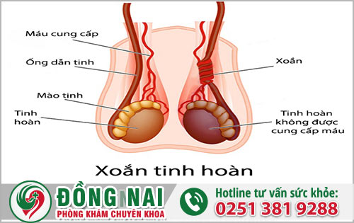 Xoắn tinh hoàn nguy cơ cao dẫn đến hoại tử nguy hiểm